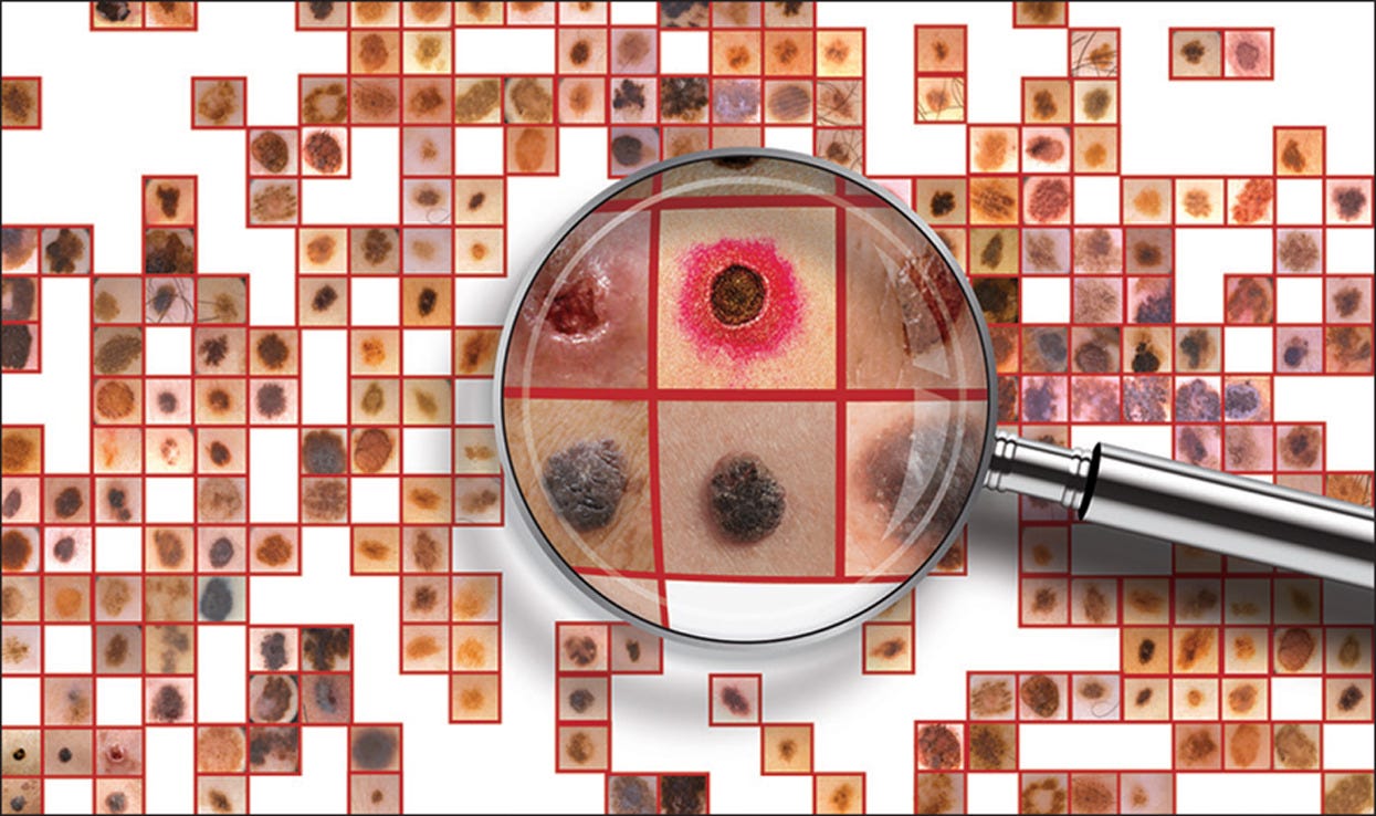 Skin Cancer Classifier